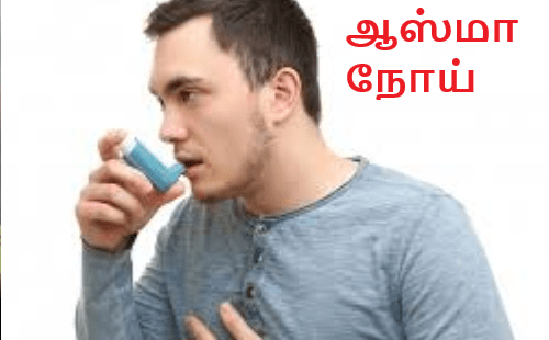 ஆஸ்மா நோய் இலங்கையில் அதிகரிப்பு