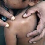 2025 ஆம் ஆண்டில் 1282 புதிய தொழுநோய் பதிவாகியுள்ளன