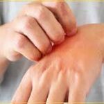 தொழுநோய் நோயாளிகளில் 15 வயதுக்குட்பட்ட குழந்தைகள்