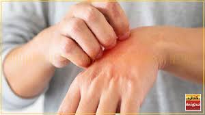 தொழுநோய் நோயாளிகளில் 15 வயதுக்குட்பட்ட குழந்தைகள்