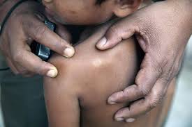 2025 ஆம் ஆண்டில் 1282 புதிய தொழுநோய் பதிவாகியுள்ளன